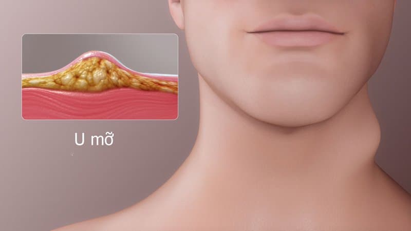 Ung thư mô mỡ là gì? Triệu chứng, Nguyên nhân và Phương pháp điều trị ung thư mô mỡ
