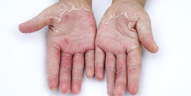 Tiểu đường bị ngứa da là gì? Những điều cần biết về tiểu đường bị ngứa da