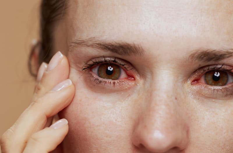Hội Chứng Tự Miễn Sjogren: Nguyên Nhân, Triệu Chứng Và Hướng Điều Trị