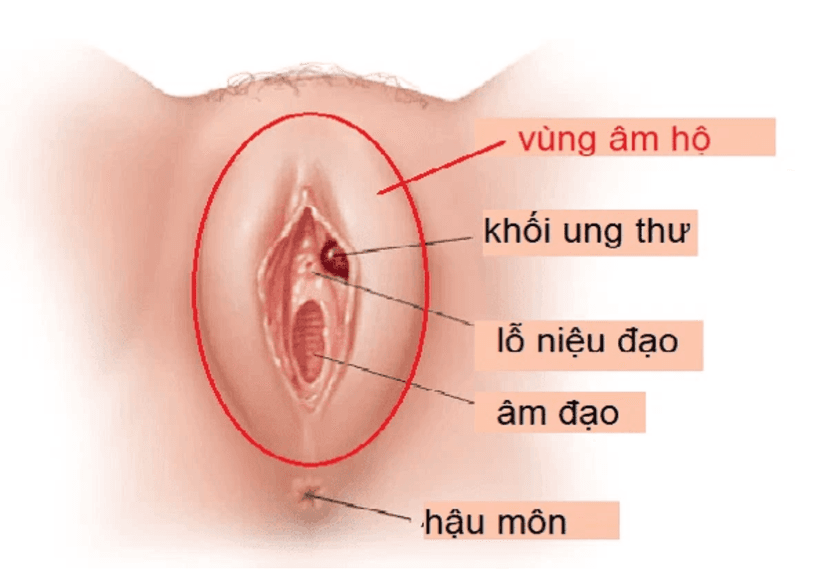 Ung Thư Âm Hộ: Tổng Quan, Triệu Chứng và Cách Phòng Ngừa