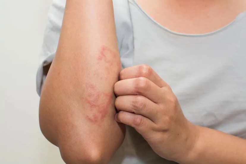 U Sùi Thể Nấm (Mycosis Fungoides): Ung thư Hạch Tế bào T Hiếm Gặp trên Da