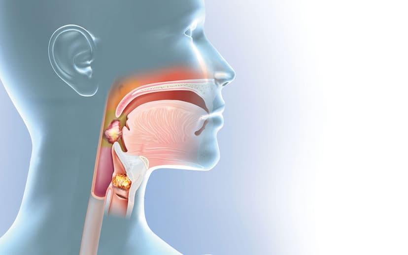 Ung thư vòm họng: Biểu hiện, nguyên nhân, điều trị và phòng bệnh