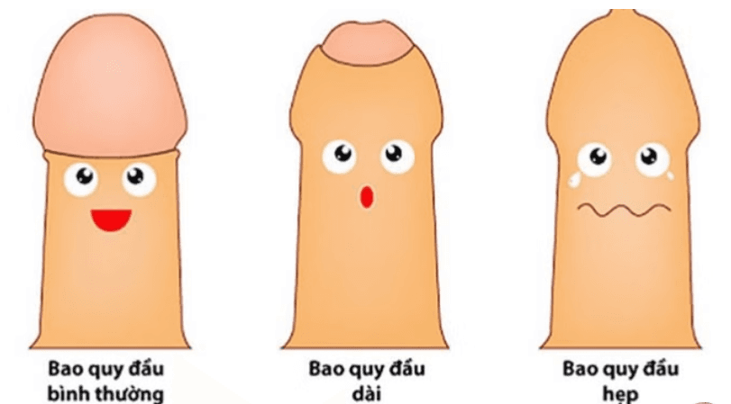 Hẹp bao quy đầu: Những điều cần biết về bệnh