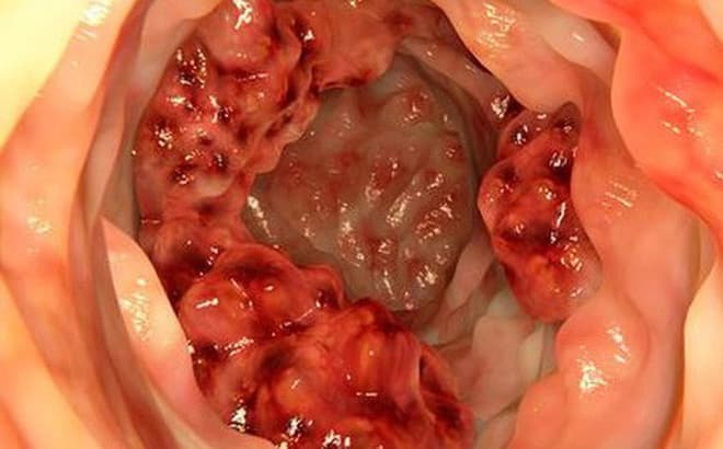 Ung thư đại tràng là gì? Những điều bạn cần biết về bệnh này