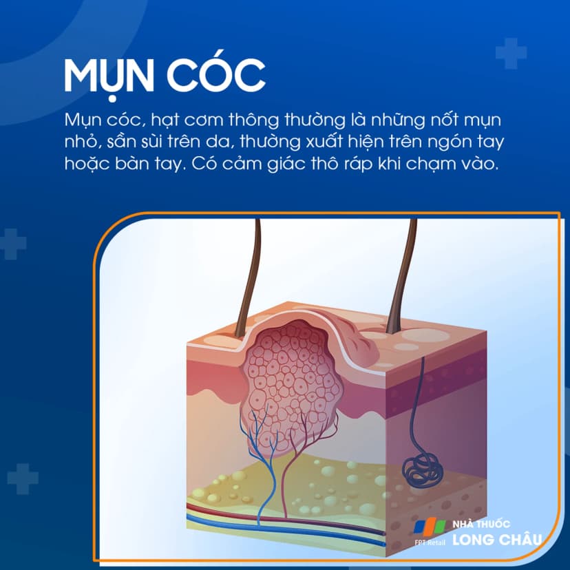 Mụn cóc, hạt cơm là gì? Nguyên nhân gây bệnh, phương pháp điều trị và nguyên tắc phòng ngừa