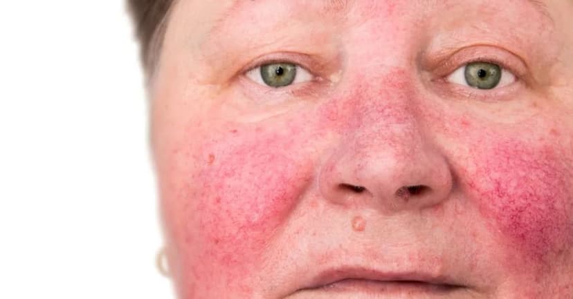 Hội chứng carcinoid là gì? Những điều cần biết về hội chứng carcinoid