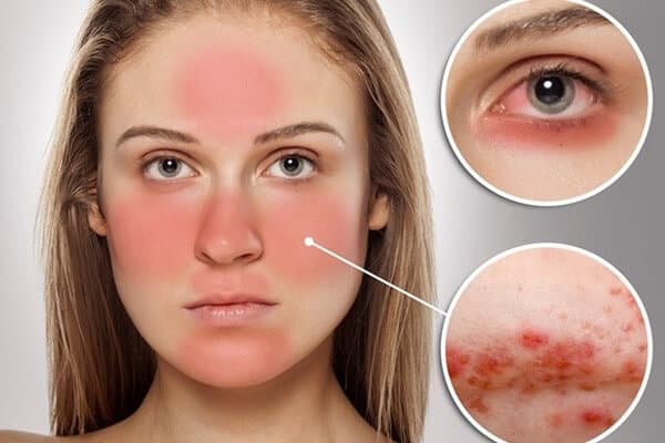 Lupus Ban Đỏ Hệ Thống (SLE): Tổng quan, Triệu chứng và Phương pháp điều trị