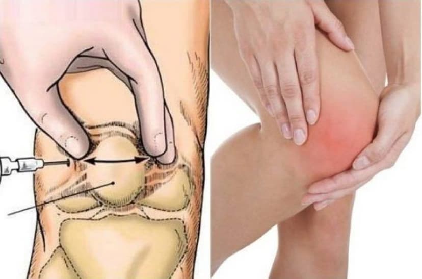 Viêm khớp nhiễm khuẩn sinh mủ là gì? Những điều cần biết về viêm khớp nhiễm khuẩn sinh mủ