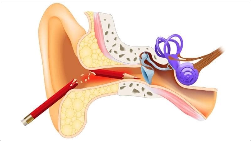 Dị vật trong tai: Dấu hiệu, nguyên nhân, chẩn đoán và điều trị