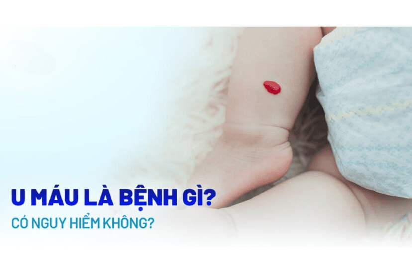 U máu: Nguyên nhân, triệu chứng, phòng ngừa và điều trị