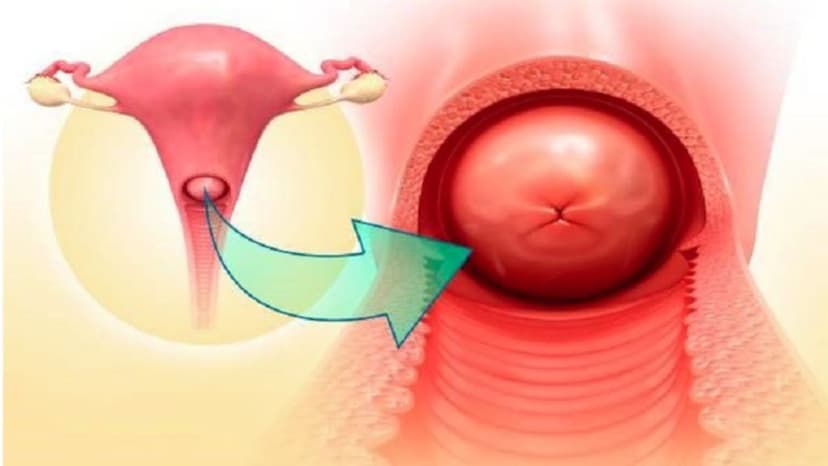 Chít hẹp cổ tử cung là gì? Nguyên nhân, triệu chứng và cách điều trị