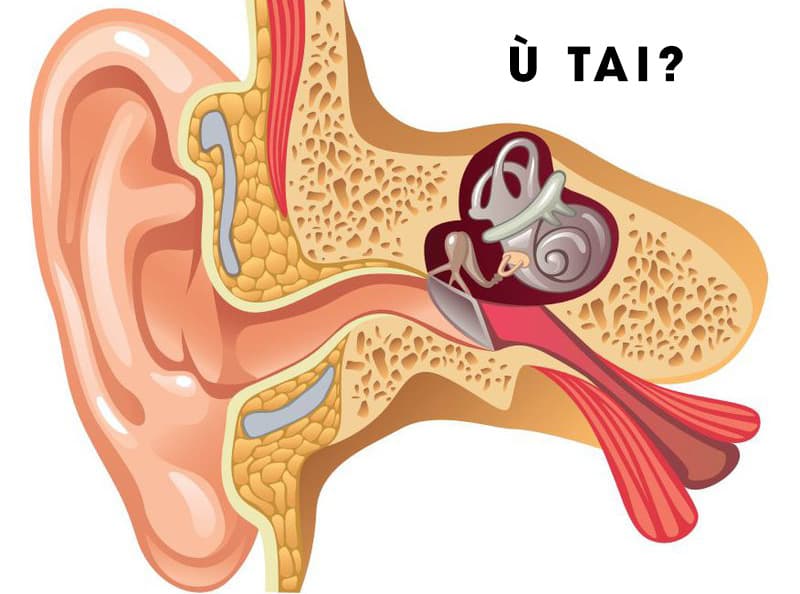 Nguyên nhân gây ù tai và cách khắc phục