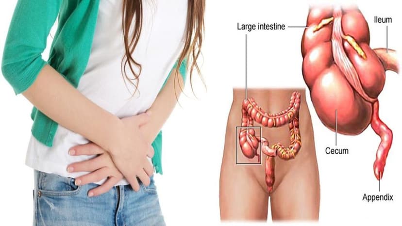 Viêm phúc mạc là gì? Những điều cần biết về viêm phúc mạc