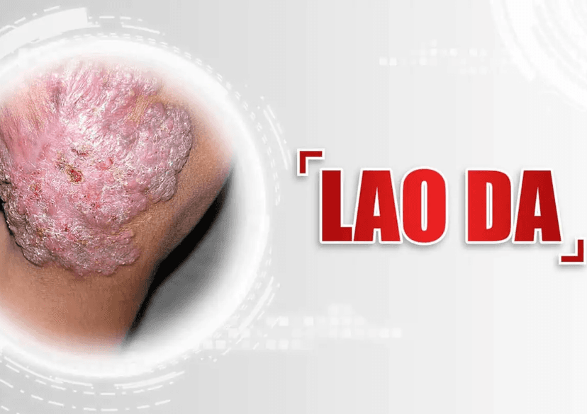 Lao Da (Tuberculosis Cutis): Nguyên nhân, triệu chứng và phác đồ điều trị