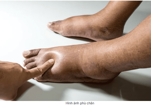 Phù chân là gì? Những điều cần biết về phù chân