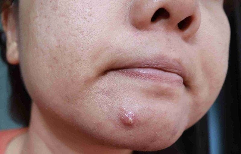 Mụn bọc là gì? Những điều cần biết về mụn bọc