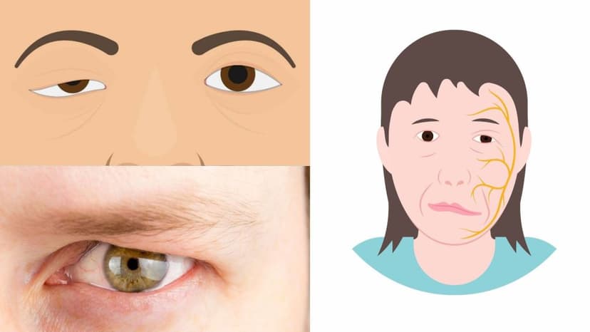 Nhược cơ: Nguyên nhân, triệu chứng, cách điều trị và phòng ngừa
