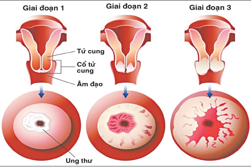 Ung thư cổ tử cung là gì? Nguyên nhân, triệu chứng và cách điều trị