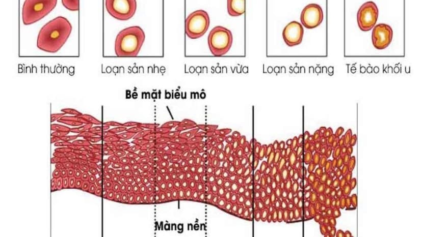 Loạn sản cổ tử cung là gì? Nguyên nhân, triệu chứng và cách điều trị