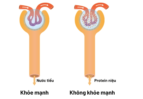 Đạm Niệu Là Gì? Những gì mà bạn cần biết về căn bệnh này.