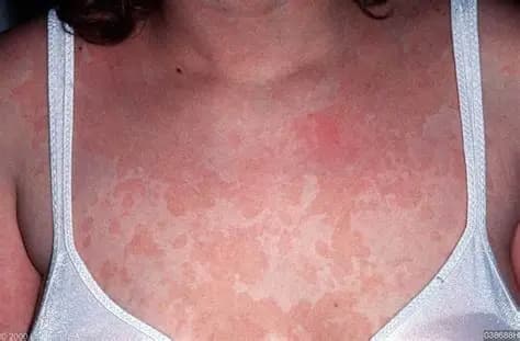 Lang Ben Là Gì? Nguyên Nhân, Triệu Chứng Và Cách Điều Trị Hiệu Quả