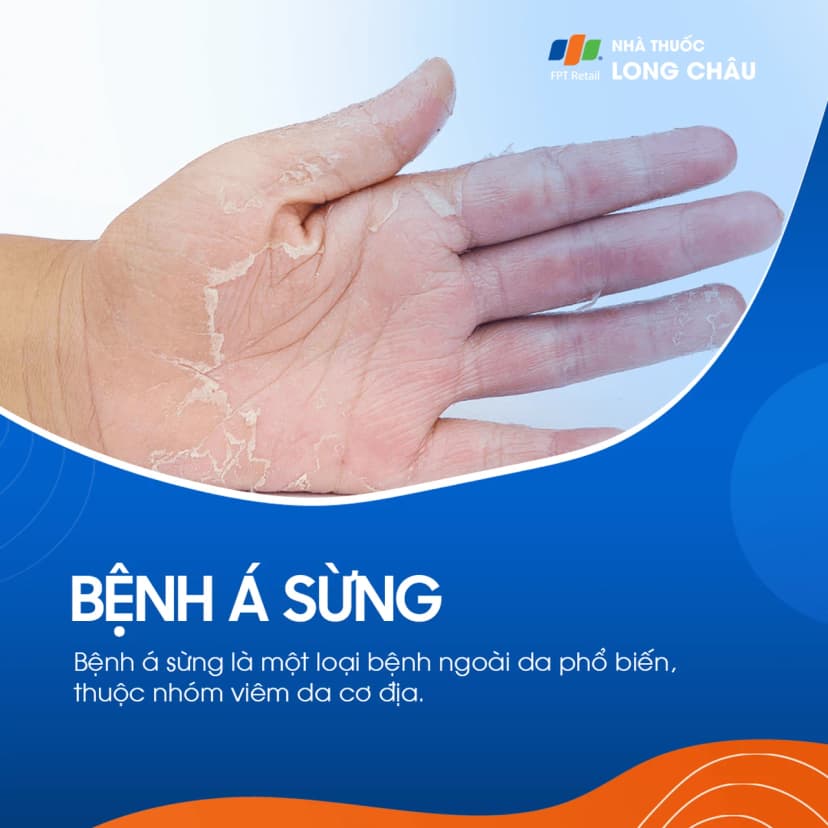 Bệnh á sừng là gì? Nguyên nhân gây bệnh và nguyên tắc phòng ngừa
