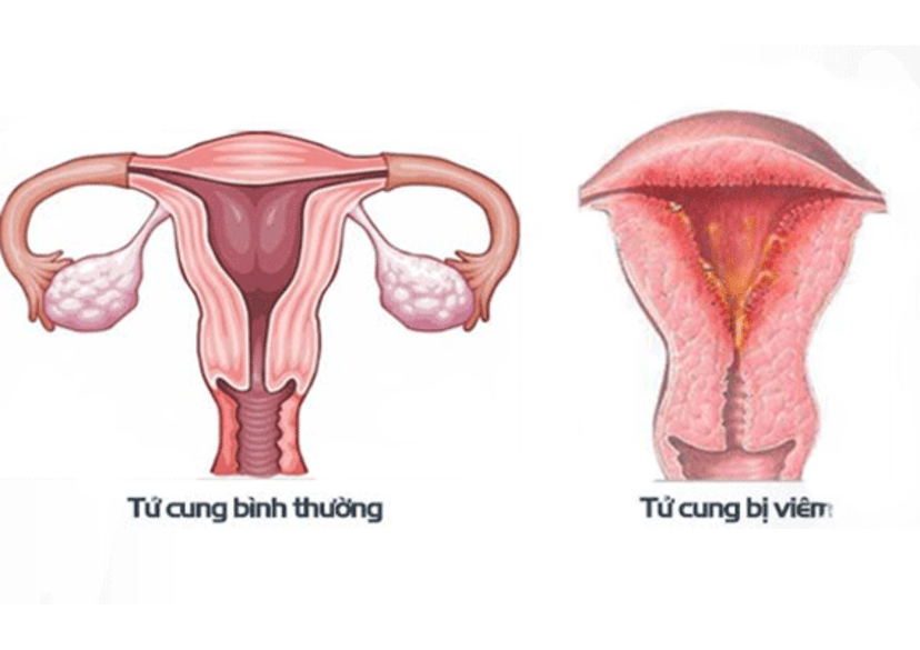 Viêm Nội Mạc Tử Cung: Nguyên Nhân, Triệu Chứng Và Cách Điều Trị Hiệu Quả