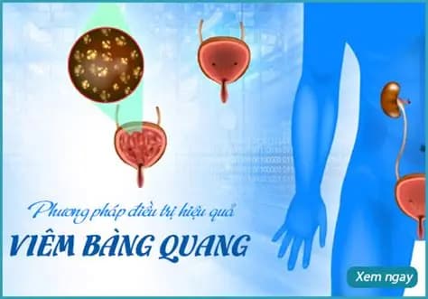 Viêm Bàng Quan Là Gì? Những Điều Cần Biết Về Viêm Bàng Quang