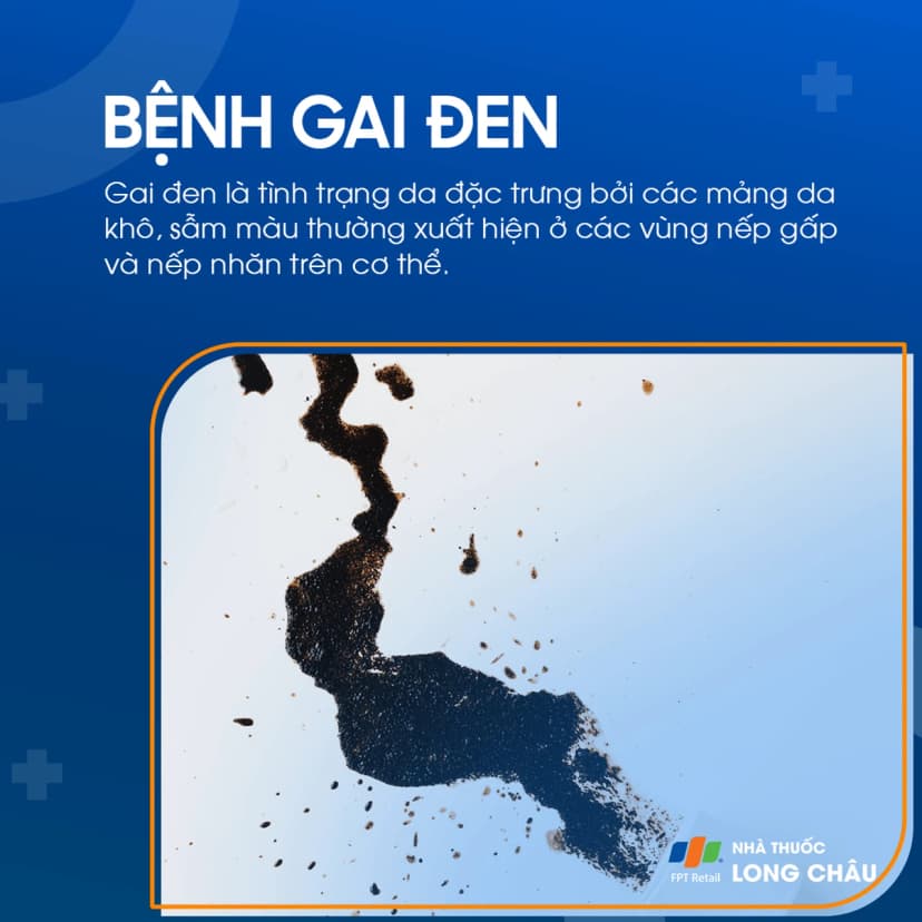 Gai đen là gì? Triệu chứng và cách điều trị gai đen