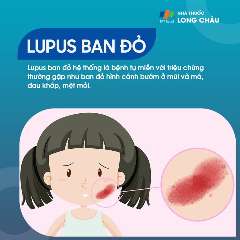 Lupus ban đỏ hệ thống là gì? Tại sao bạn mắc bệnh?