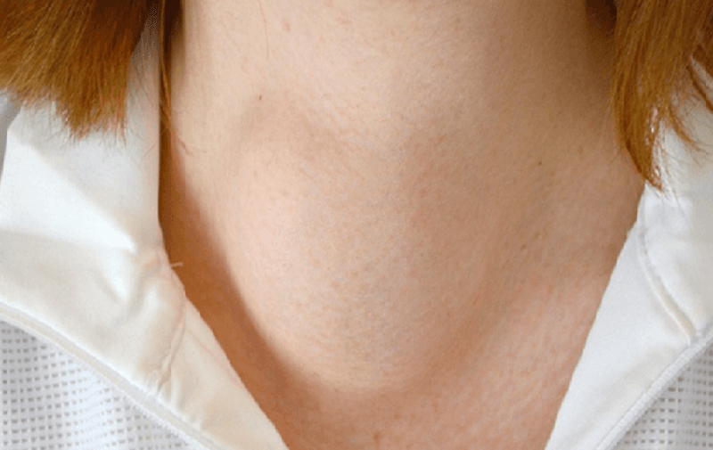 Nhiễm độc giáp là gì? Những điều cần biết về nhiễm độc giáp