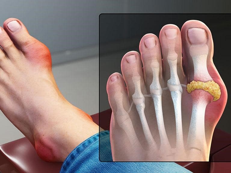 Bệnh Gout (Gút): Nguyên nhân, Triệu chứng, Chẩn đoán và Điều Trị Hiệu Quả