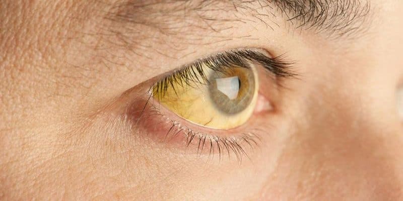 Bệnh gan sung huyết là gì? Triệu chứng, nguyên nhân và cách điều trị bệnh gan sung huyết