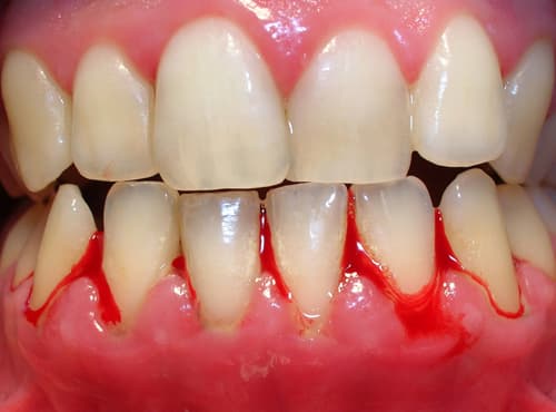 Viêm Lợi: Dấu hiệu, Nguyên nhân và Cách điều trị hiệu quả