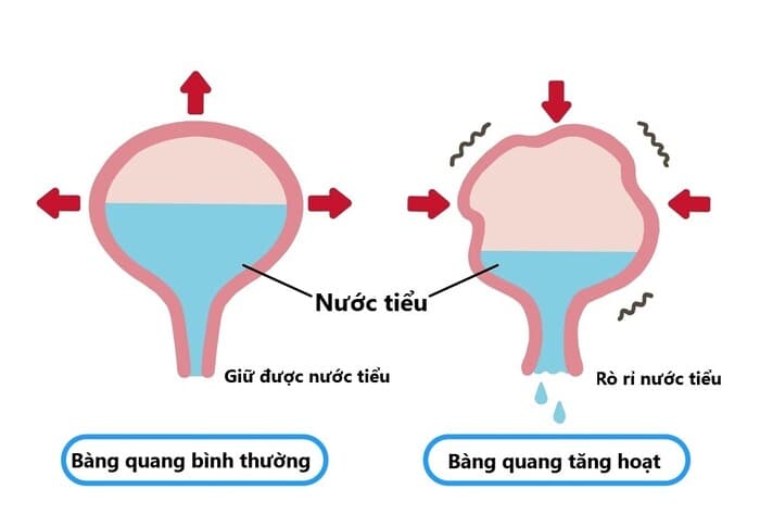 Bàng quang tăng hoạt là gì? Những điều cần biết về bàng quang tăng hoạt