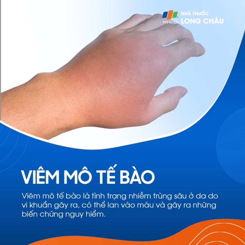 Viêm mô tế bào: Nguyên nhân, triệu chứng và điều trị