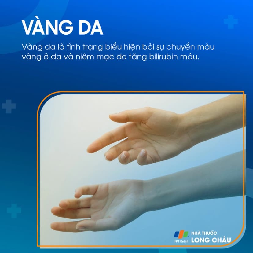 Vàng da: Nguyên nhân, triệu chứng và cách điều trị