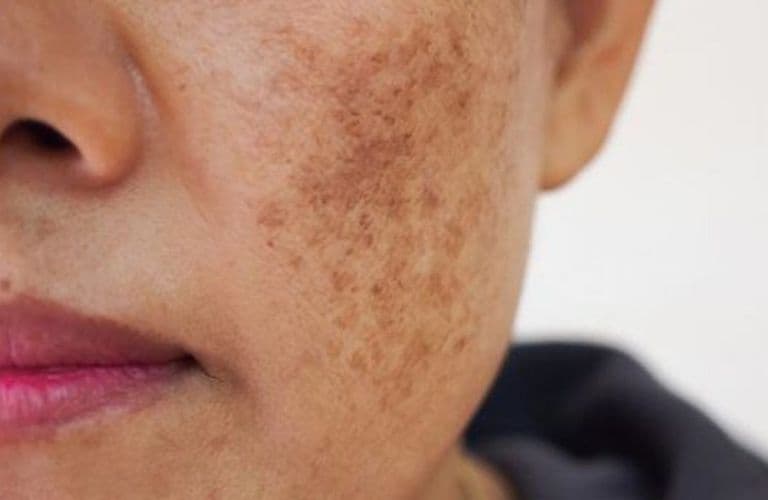 Sạm da là gì? Nguyên nhân, triệu chứng và cách cải thiện hiệu quả