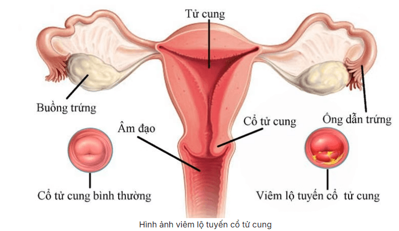 Viêm lộ tuyến cổ tử cung là gì? Những điều cần biết về bệnh