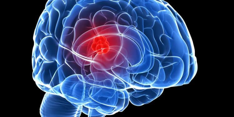 Thoát vị não là gì? Những điều cần biết về thoát vị não