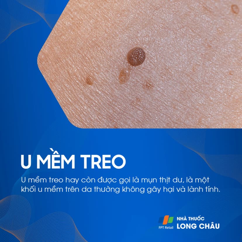 U mềm treo là gì? Nguyên nhân, triệu chứng và cách điều trị
