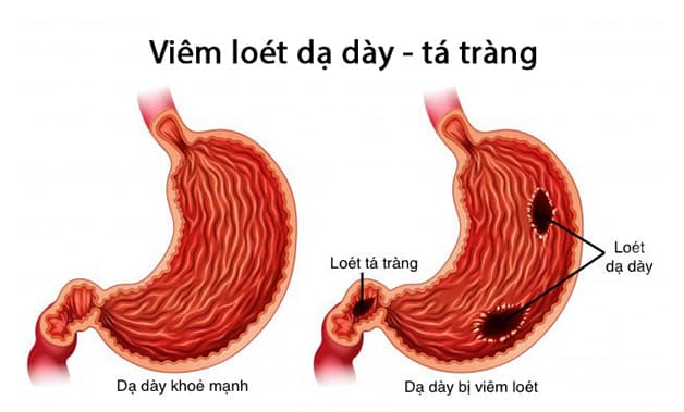 Vì Sao Căng Thẳng Khiến Dạ Dày Bị Viêm Loét? Cách Phòng Ngừa Hiệu Quả