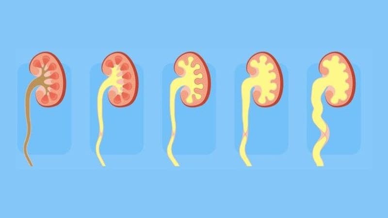 Thận ứ nước là gì? Dấu hiệu, nguyên nhân, chẩn đoán và phương pháp điều trị