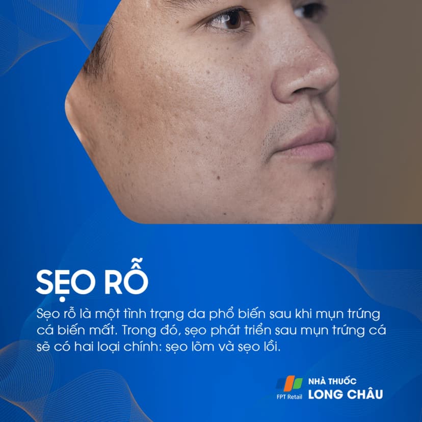 Sẹo rỗ là gì? Nguyên nhân, triệu chứng và cách điều trị