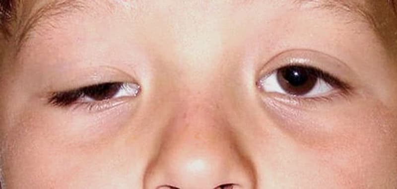 Sụp mi là gì? Dấu hiệu, nguyên nhân, chẩn đoán và điều trị