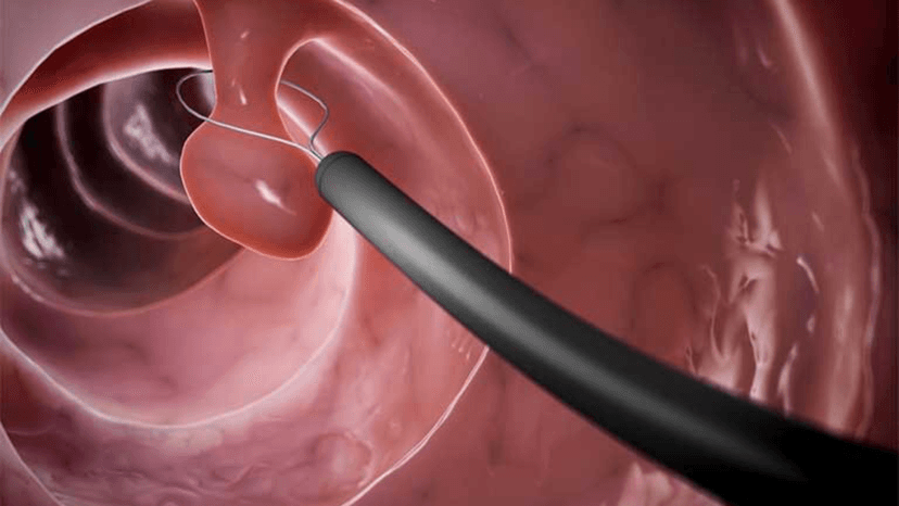 Polyp tử cung là gì?
