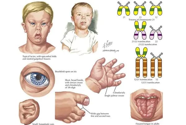 Down là gì? Những điều cần biết về hội chứng Down