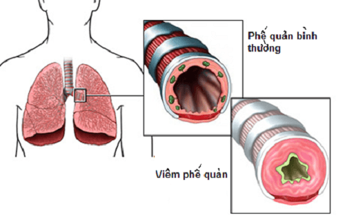 Viêm Phế Quản Là Gì? Nguyên Nhân, Triệu Chứng Và Cách Điều Trị Hiệu Quả