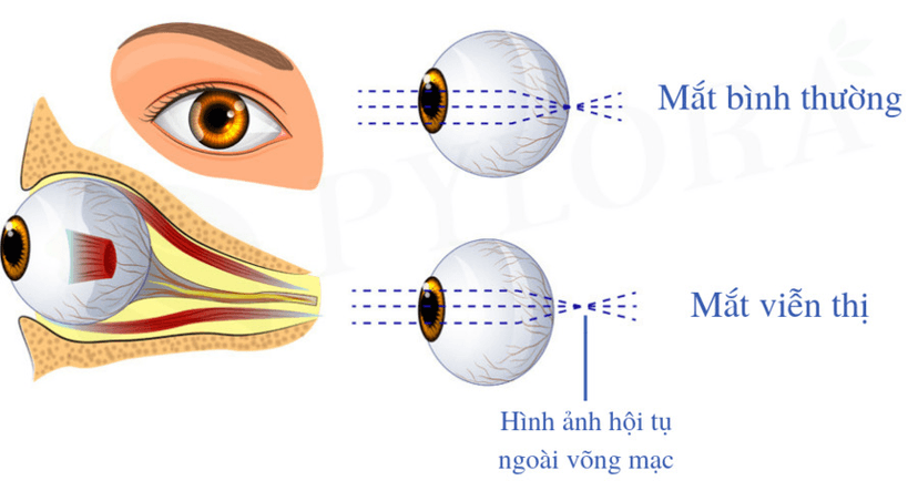 Viễn thị là gì? Nguyên nhân, triệu chứng, cách phòng ngừa và điều trị hiệu quả