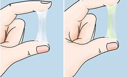 Bệnh huyết trắng là gì? Những điều cần biết về bệnh